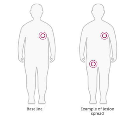 Graphic of a person with lesions observed in any anatomic region not seen at baseline